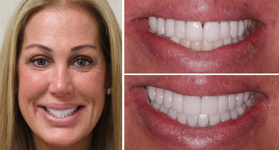 Makeover Palm Beach Gardens Rudnick Dentistry Our Smile Gallery