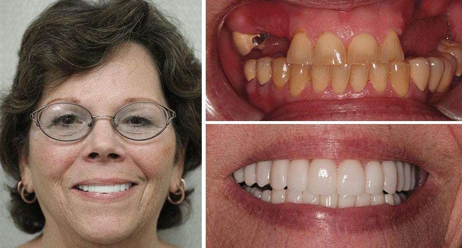 Makeover Palm Beach Gardens Rudnick Dentistry Our Smile Gallery
