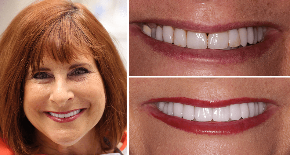 Makeover Palm Beach Gardens Rudnick Dentistry Our Smile Gallery