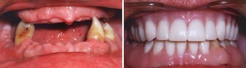Carl's makeover Palm Beach Gardens Carl's teeth before and after his smile makeover Palm Beach Gardens