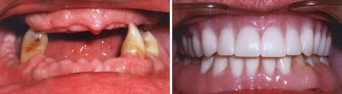 Carl's teeth before and after his smile makeover Palm Beach Gardens