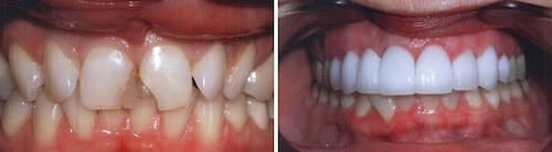 Champa's smile before and after his makeover Palm Beach Gardens