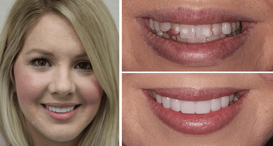 A female patient smiling with her before and after images next to her