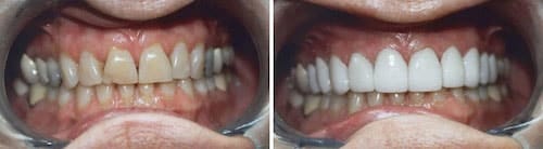 Janet's teeth before and after her smile makeover Palm Beach Gardens