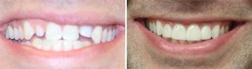 Justin enjoyed a smile makeover Palm Beach Gardens Justin's teeth before and after his smile makeover Palm Beach Gardens