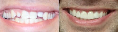 Justin's teeth before and after his smile makeover Palm Beach Gardens