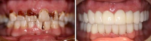 Ken's makeover Palm Beach Gardens Ken's smile makeover in Palm Beach Gardens