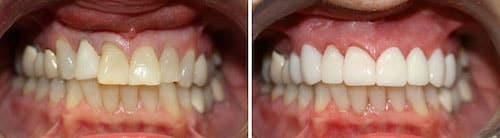 Linda's teeth before and after her smile makeover Palm Beach Gardens