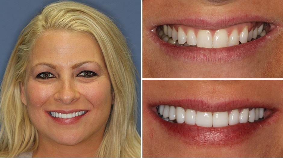 A female patient smiling with her before and after images next to her