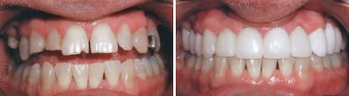 Michael's makeover Palm Beach Gardens Michael's teeth before and after his smile makeover Palm Beach Gardens