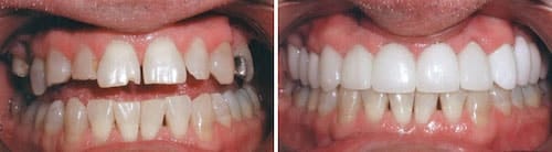 Michael's teeth before and after his smile makeover Palm Beach Gardens