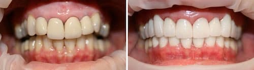 Michelle's makeover Palm Beach Gardens Michelle's smile makeover Palm Beach Gardens