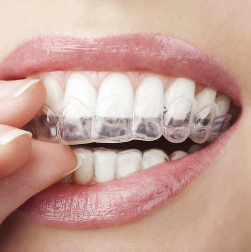 With Invisalign®, nobody has to know you're wearing aligners except you! A Palm Beach Gardens orthodontics patient putting in clear aligners by Invisalign®