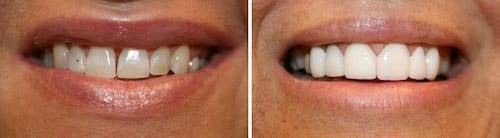 Rachel's makeover Palm Beach Gardens Rachel's teeth before and after her smile makeover Palm Beach Gardens