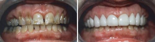 Rona's teeth before and after her smile makeover Palm Beach Gardens