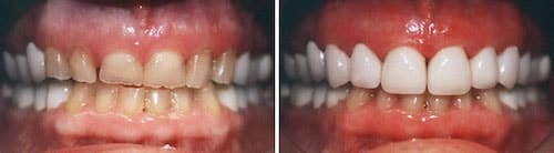 Steve''s teeth before and after his makeover Palm Beach Gardens