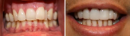 Tarek's teeth before and after his smile makeover Palm Beach Gardens