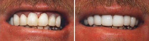 Tim's makeover Palm Beach Gardens Tim's teeth smile makeover Palm Beach Gardens