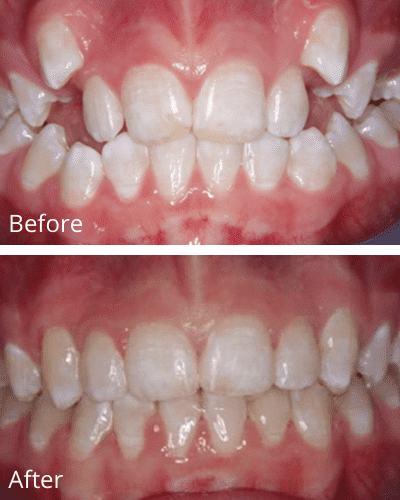 Image of the front teeth before and after procedures