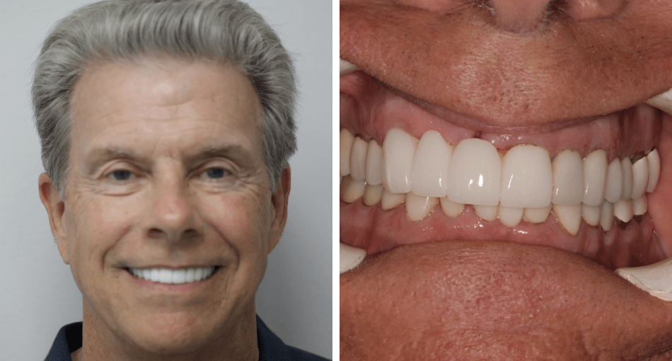 Collage: A middle-aged man with a beautiful smile on the left and his front teeth photo before the smile makeover on the right.