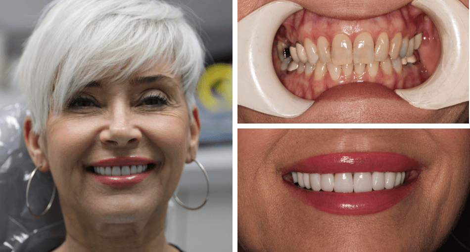 Collage: A woman with a lovely smile on the left and her photo before front teeth photo before the smile makeover on the right