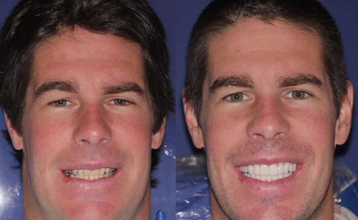 Man is smiling before and after TMJ procedures