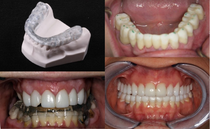 Photo of the front teeth before and afterTMJ procedured
