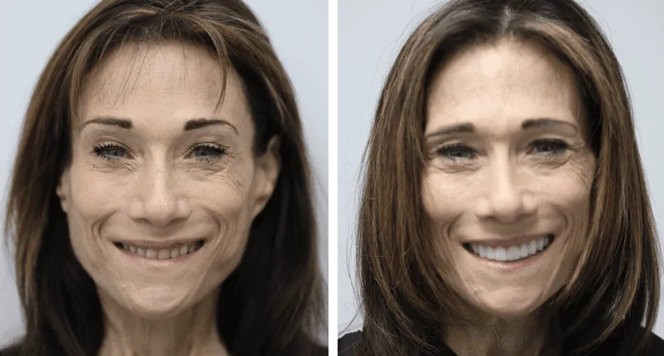 Collage: A middle-aged woman with a good-looking smile on the left and her photo before the dental procedures on the right.