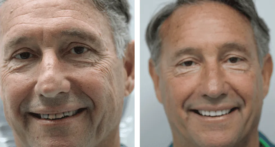 Collage: A middle-aged man with an attractive smile on the left and his photo before the smile makeover on the right.