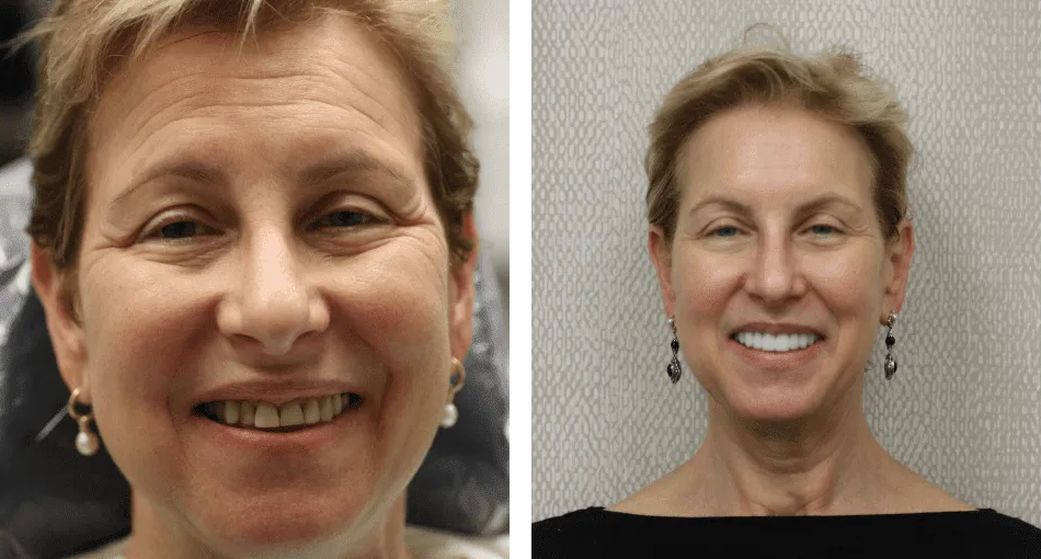 Collage: A middle-aged woman with a stunning smile on the left and her photo before the dental procedures on the right.