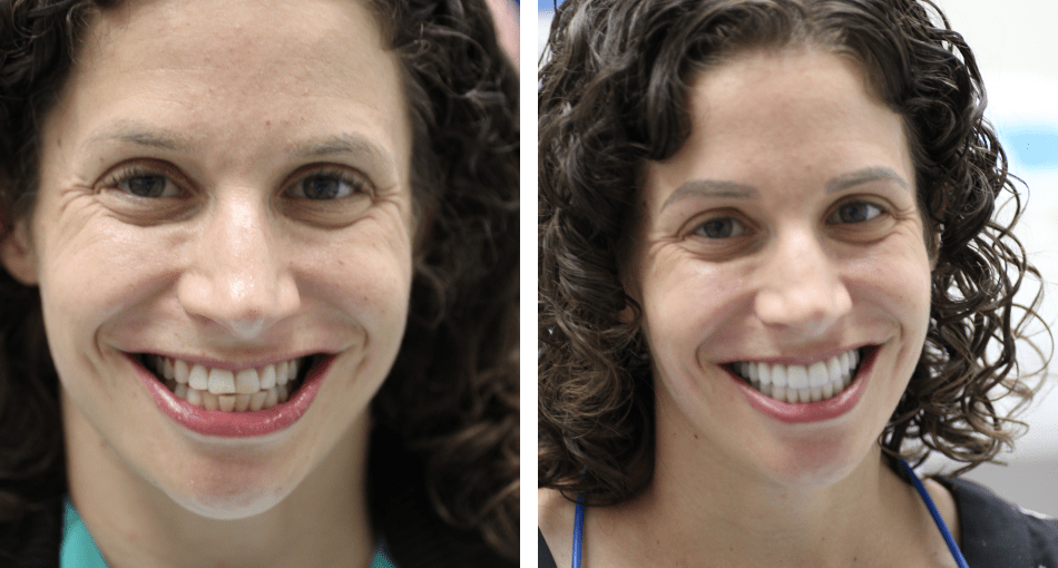 Collage: A woman with a lovely smile on the left and her photo before the dental procedures on the right