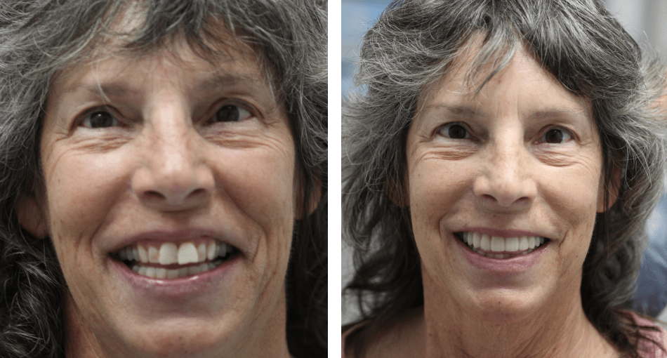 Collage: A middle-aged woman with a gorgeous smile on the left and her photo before the dental procedures on the right