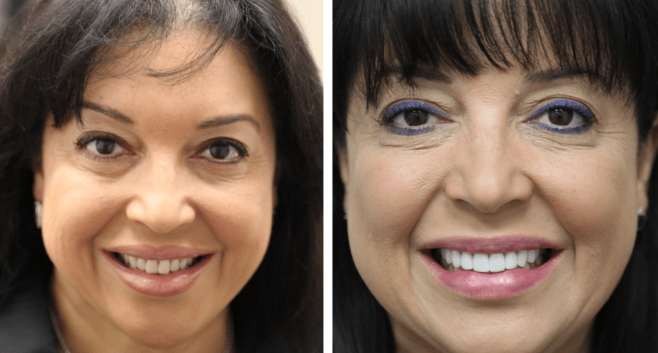 Collage: A woman with a good-looking smile on the left and her photo before the dental procedures on the right